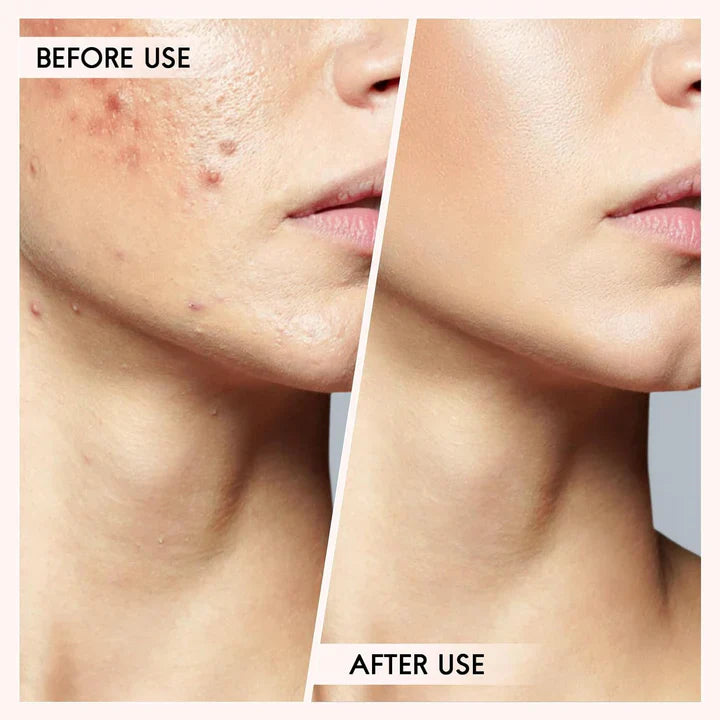 Zestaw do Usuwania Wągrów i Pryszczy